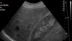 DIAGNOSI ECOGRAFICA DI STEATOSI EPATICA