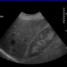 DIAGNOSI ECOGRAFICA DI STEATOSI EPATICA