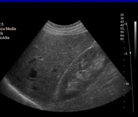 DIAGNOSI ECOGRAFICA DI STEATOSI EPATICA